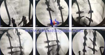 首套國産鈷鉻鉬脊柱內固定系統啓用圖片