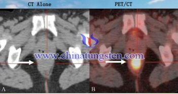 PET-CT 스캐너에 적용된 텅스텐 합금 콜리메이터