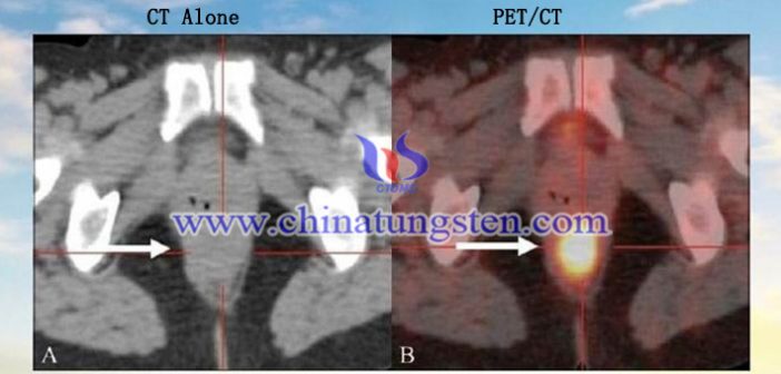 PET-CT 스캐너에 적용된 텅스텐 합금 콜리메이터